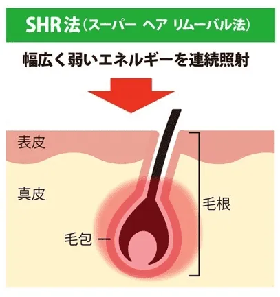 おおかみ脱毛秋葉原店のSHR法